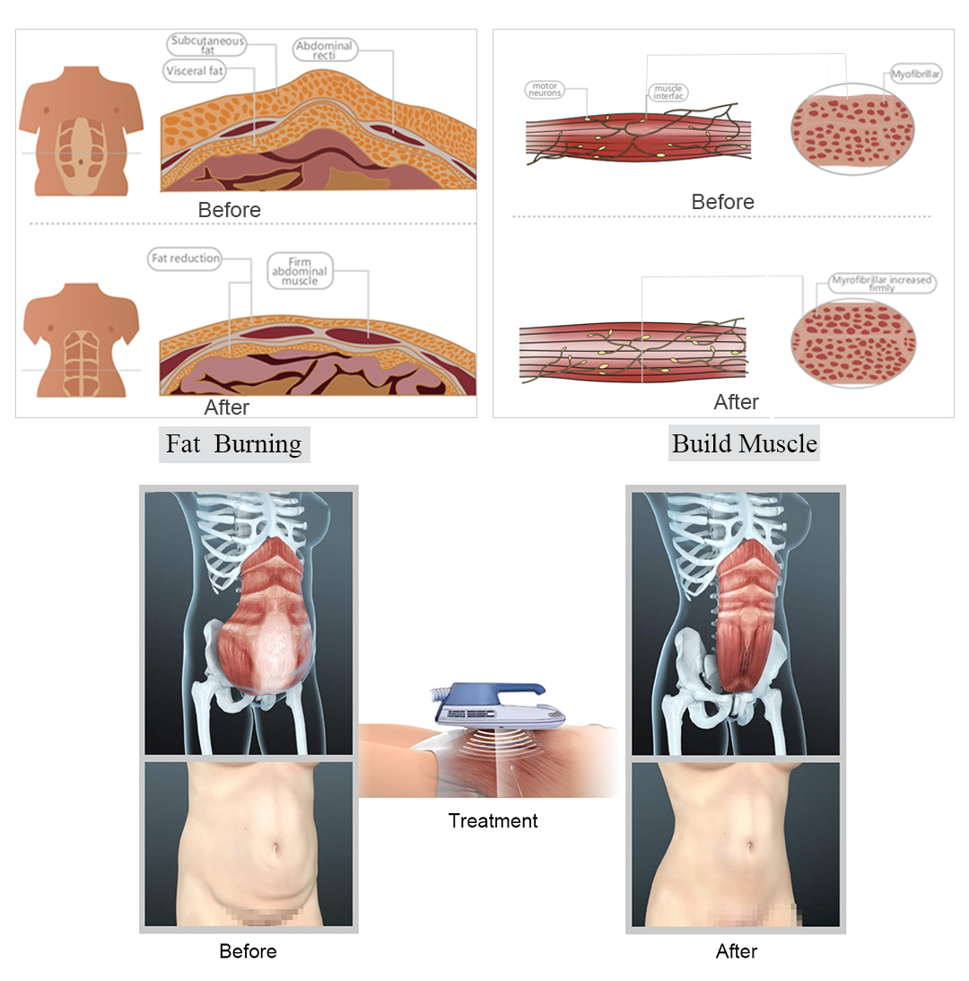 Tesla Muscle Stimulator Machine Electromagnetic Wave EMS Fat Burning Machine