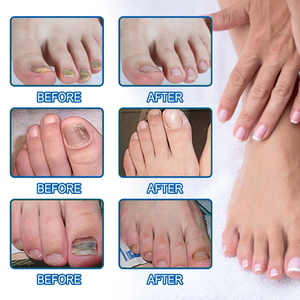 Parche <span class=keywords><strong>de</strong></span> hongos <span class=keywords><strong>en</strong></span> las uñas <span class=keywords><strong>de</strong></span> etiqueta privada, antifúngico Extra fuerte con 40% <span class=keywords><strong>de</strong></span> urea, uñas descoloridas dañadas y frágiles gruesas para manos y pies - Product Image 6