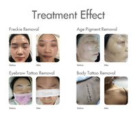 Machine professionnelle de peeling au laser au carbone pour l'élimination des tatouages, traitement de peeling au carbone avec 3 têtes de traitement, livraison rapide