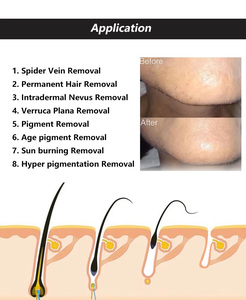 กำจัดขนถาวรคุณภาพสูง กำจัดเส้นเลือดทุกสีด้วยอิเล็กโทรไลซิส กำจัดเส้นเลือด กำจัดขนบนหนังศีรษะ พร้อมการรักษาหนังศีรษะ - Product Image 4