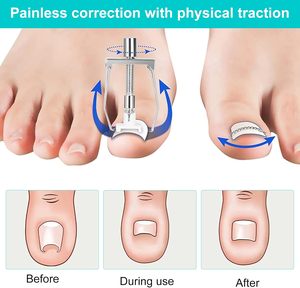 Kit de Correction des Ongles Incarnés, Ensemble de Soins des Pieds, <span class=keywords><strong>Pince</strong></span> à Ongles Courbée en Acier Inoxydable, <span class=keywords><strong>Traitement</strong></span> des Paronychies, Écologique et Esthétique - Product Image 3