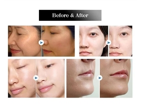 Vente en gros de nouveaux injecteurs de mésothérapie électriques de type U225, machine d'injection de mésothérapie pour les spas de beauté - Product Image 4