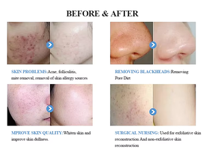 2025 popüler çok fonksiyonlu hidro elmas dermabrazyon yüz güzellik makinesi 10-in-1 derin temizlik oksigen Jet soyucu cilt - Product Image 5