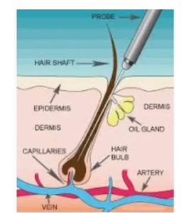 Élimination des pigments de l'âge, nouvelle électrolyse RBS, épilation longue durée, élimination des varices, convient à une utilisation sur tout le corps - Product Image 3