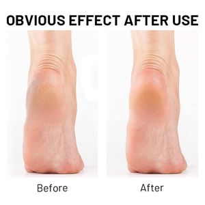 Private Label Instant Instant Foot Peeling Spray rimuovere la <span class=keywords><strong>pelle</strong></span> morta screpolata tacchi ruvidi <span class=keywords><strong>pelle</strong></span> <span class=keywords><strong>secca</strong></span> della punta e calli rimuovere rapidamente la <span class=keywords><strong>pelle</strong></span> morta - Product Image 5