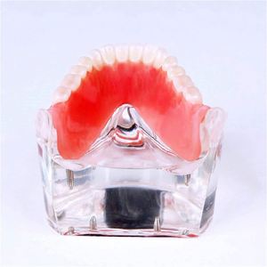 KyrenMed-Localisateur dentaire à quatre implants, modèle de prothèse inférieure, dents amovibles, modèle <span class=keywords><strong>mandibulaire</strong></span> - Product Image 2