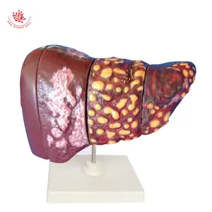 Fatty liver patient education supplies liver pathology model