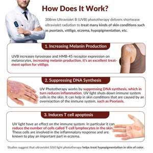 Dispositivo de Terapia de Luz Excimer de 308nm para el Tratamiento del Vitiligo, <span class=keywords><strong>Dermatitis</strong></span> Alérgica y Eczema Seco - Product Image 2