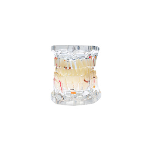 Modelo patológico de boca completa con 32 dientes; modelo dental patológico completo; modelo dental desmontable; restauración de implantes - Product Image 1