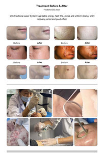 Macchina Laser frazionaria CO2 & RF per la pelle che stringe & attrezzatura <span class=keywords><strong>estetica</strong></span> di bellezza di rimozione della cicatrice per il trattamento del Laser del fronte - Product Image 3