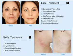 13.3 Inch Portable Facial Skin Analyzer Machine New Styles 3D Face Mirror Scanner LED Light Source Acne Pigmentation Analysis - Product Image 6