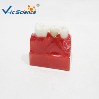 Modèle d'implant dentaire agrandi 4 fois, couronne et pont amovibles pour l'éducation des dentistes et des patients, certifié CE ISO ROHS CNAS
