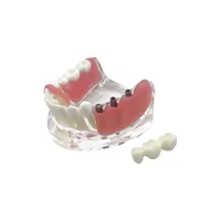 Modelo de Dientes de Mandíbula Inferior Removible con Implante, Restauración de Puente, Modelo de Implante Dental para Educación, Enseñanza, Estudio y Práctica