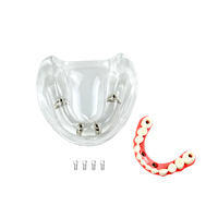 YOUYA DENTAL Nuevo Modelo de Implante Dental de Resina MX-089, 4 Implantes, Mandíbula Baja, Puente Maryland, Restauración de Sobredentadura, Tipodonto Educativo