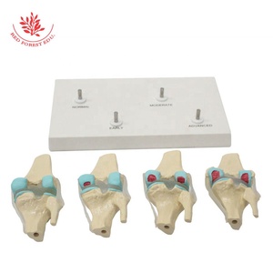 Artrose Kniegewricht <span class=keywords><strong>Model</strong></span> Frt033 Levensgrote Transparante Ligament 4 Stadium Pathologische Ontwikkeling Medisch Anatomisch <span class=keywords><strong>Model</strong></span> - Product Image 4