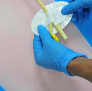 Perlengkapan Medis Jarum Indwelling Perangkat Pengaman Tabung Nasogastrik Sekali Pakai Perangkat Fiksasi Kateter Kustom - Product Image 4