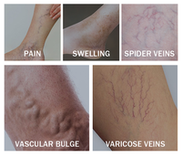 Le gel composé OEM/ODM de varices d'Escinate de sodium favorisent la circulation sanguine empêchent la stase de sang épaississent la veine