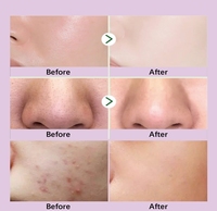 Masker Wajah Label pribadi OEM, pembersihan dalam daun Perilla Masker Wajah lumpur Eksfoliasi dengan Pengontrol Minyak penghilang komedo