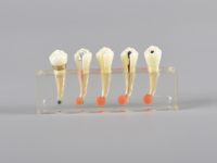 Modelo de estudio Dental, tratamiento endodontico, modelo de educación para pacientes