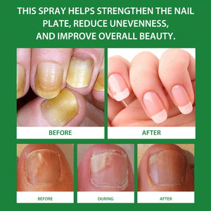 Marque Blanche 2025 Nouvelle Arrivée Spray Anti-<span class=keywords><strong>Mycose</strong></span> des Ongles 7 Jours Répare les Ongles et Cuticules Endommagés Produits de Soin 30ml MOOYAM Spray Ongles - Product Image 4