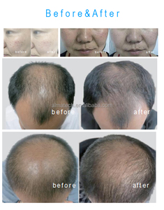 MESO SKIN Hair Growth Machine No Needle Mesotherapy for Baldness & Skin Rejuvenation Non-Invasive Hair Regrowth - Product Image 6