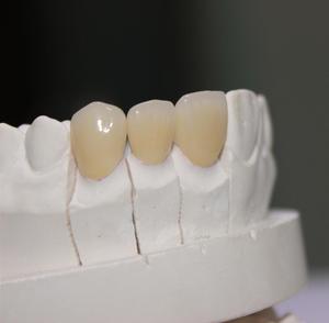 De alta calidad de CAD/CAM personalizado de circonio corona Dental - Product Image 1