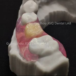 <span class=keywords><strong>Prothèse</strong></span> <span class=keywords><strong>dentaire</strong></span> flexible Valplast <span class=keywords><strong>Prothèse</strong></span> <span class=keywords><strong>temporaire</strong></span> sans meulage des dents, pilier invisible, esthétique, opération facile et rapide - Product Image 6