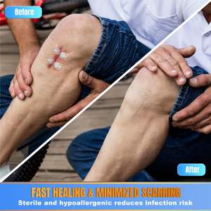 Pansements Adhésifs Papillons pour Plaies, Kits de Fermeture d'Urgence pour Grandes Lacérations, Bandages pour Soins de Grandes Plaies - Product Image 3