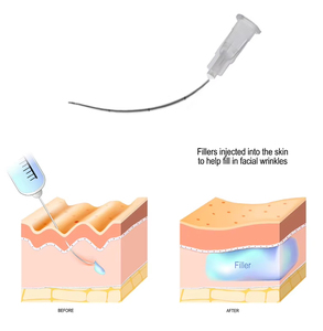 Aguja de cánula microcánula de punta roma estéril Liderson de seguridad médica 23G/25G para inyección, certificada CE Clase II, venta al por mayor - Product Image 6