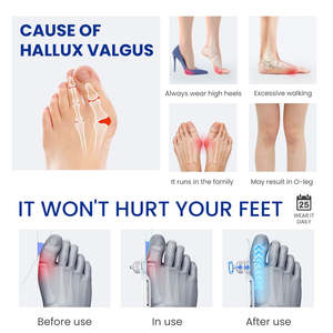 <span class=keywords><strong>Corrector</strong></span> <span class=keywords><strong>de</strong></span> Juanetes Hallux Valgus con Soporte OEM, Ángulo Ajustable Mejorado, Férula Ortopédica para Alineación <span class=keywords><strong>de</strong></span> Dedos, Venta al por Mayor para Vendedores <span class=keywords><strong>Online</strong></span> - Product Image 2