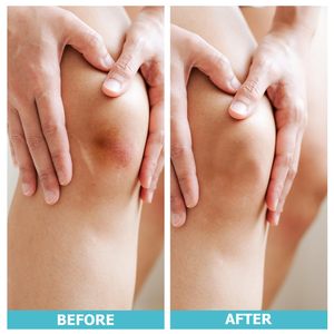 Apósito en rollo hidrocoloide para úlceras venosas del fabricante - Product Image 5
