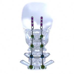 Placas de cuello preoperatorias Columna vertebral Implantes ortopédicos de titanio <span class=keywords><strong>Precio</strong></span> Implantes ortopédicos Fabricantes Implantes ortopédicos - Product Image 6