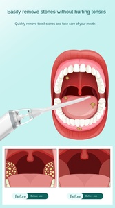 Kit Penghilang Batu <span class=keywords><strong>Tonsil</strong></span> Silikon Elektrik Carepik dengan 3 Mode & 5 Nozel untuk Perawatan dan Pembersihan Mulut - Product Image 6