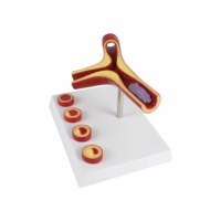 Modèle éducatif d'artérosclérose à l'échelle 10X pour l'enseignement en éducation médicale