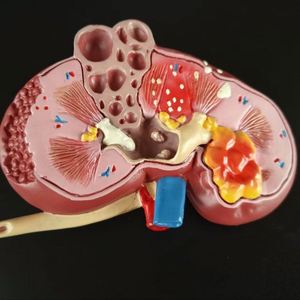 KyrenMed umano malato di anatomia del rene con calcoli urinari tumori malattia policistica a grandezza naturale modello di rene patologico - Product Image 4