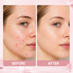 Loción Secante Nocturna 3H para el Cuidado de Granos y Imperfecciones 20ml con 25% de Calamina, Ácido Salicílico y Aceite de Árbol de Té, Solución Vegana para Manchas - Product Image 5