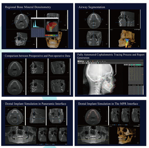 Máquina de Rayos <span class=keywords><strong>X</strong></span> <span class=keywords><strong>Dental</strong></span> CBCT Eléctrica de Baja Dosis con Imagenología Natural, Tomografía Computarizada de Haz Cónico con Cefalometría - Product Image 6