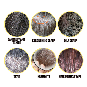 South Moon Sulfur Hair <span class=keywords><strong>Shampooing</strong></span> antipelliculaire rafraîchissant pour soulager les démangeaisons Tinea Capitis réduisant le meilleur <span class=keywords><strong>shampooing</strong></span> séborrhéique pour le cuir chevelu - Product Image 5