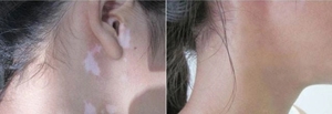 KN-5000C médical Excimer Light Excimer 308nm Laser Hand Held Psoriasis Vitiligo Cure - Product Image 6