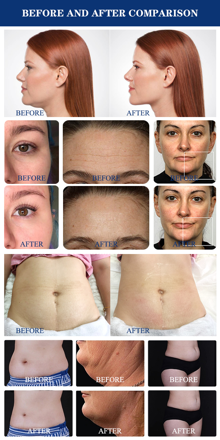Rf Vacuum Cavitation Portable Slimming Machine Breast Enlargement Cavitation Radio Frequency Three polar Facial  Corporal