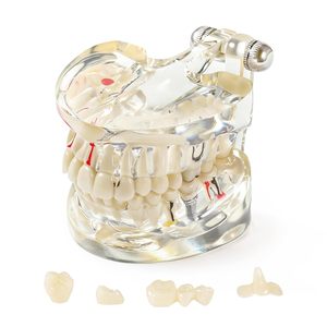 Modelo de Dientes con Enfermedades, Modelo Dental Transparente, Dientes Removibles de Resina, Modelo Patológico con Ángulo Ajustable, Modelo de Dientes para Enseñanza - Product Image 1
