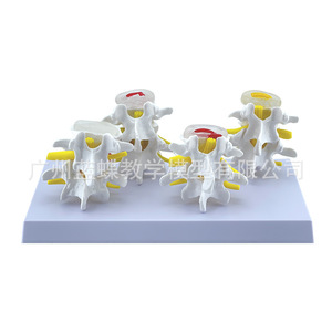 Modelo patológico de columna lumbar de cuatro etapas; modelo esquelético patológico; esqueleto deformado; modelo de columna vertebral patológica. - Product Image 2