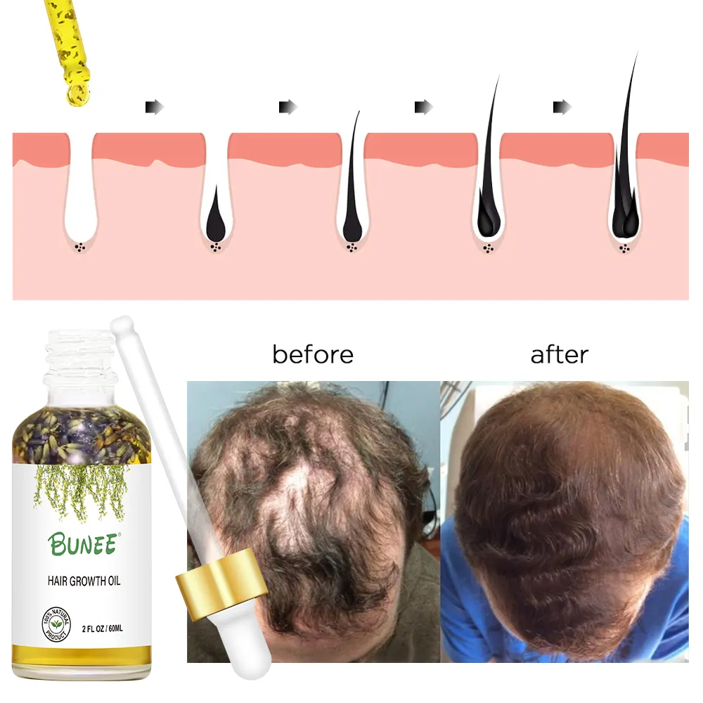 Build Your Own Label Organic Hair Regrowth Treatment Regrowth Serum Anti Hair Loss Lavender Hair Growth Oil