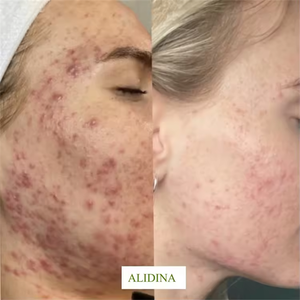 Microneedling Naturale Bio con Spugne Marine per Rimozione di Punti Neri, Acne e Pigmentazione, Peeling con Alghe e Spicole di Spongilla - Product Image 2