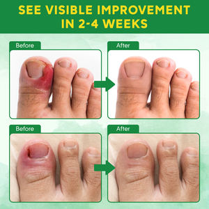 Removedor de Unha Encravada Personalizado com Rótulo Privado, Corretor de Unha Encravada em Gotas 30ml/1.01 Fl.oz - Product Image 3