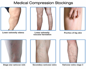 Customized <strong>Compression</strong> Pantyhose Closed Toe Seamless 30-40mmhg <strong>Women</strong> Tight <strong>Stocking</strong> for Varicose Veins - Product Image 6