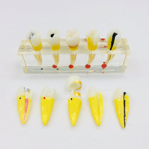 Riparazione della polpa dentale modello orale per la visualizzazione e la comunicazione - Product Image 2