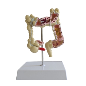 Modèle pathologique du côlon humain, modèle anatomique de l'intestin large - Product Image 3
