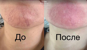 Système de <span class=keywords><strong>photorajeunissement</strong></span> 4 en 1 pour l'élimination des varices de l'araignée 980nm avec machine Beacuty pour les soins de la peau - Product Image 4