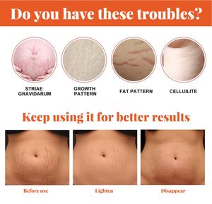 Aceite esencial para el cuidado de la piel prenatal y posparto, piel del vientre femenino, arrugas sueltas, esencia hidratante - Product Image 3